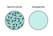 Traitement naturel de l’azoospermie